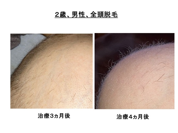 円形脱毛症　病院